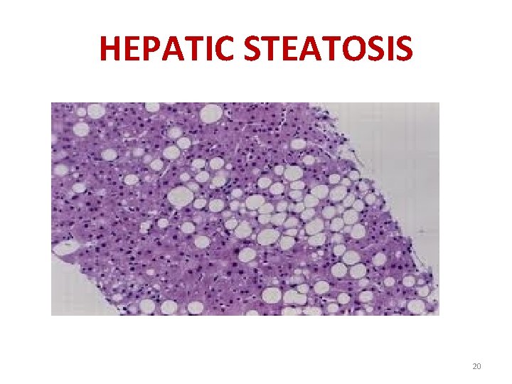 HEPATIC STEATOSIS 20 