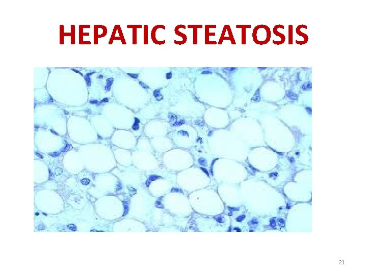 HEPATIC STEATOSIS 21 