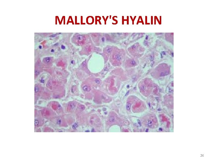 MALLORY'S HYALIN 26 