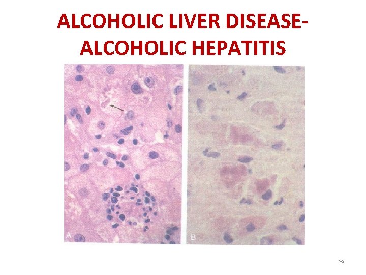 ALCOHOLIC LIVER DISEASEALCOHOLIC HEPATITIS 29 