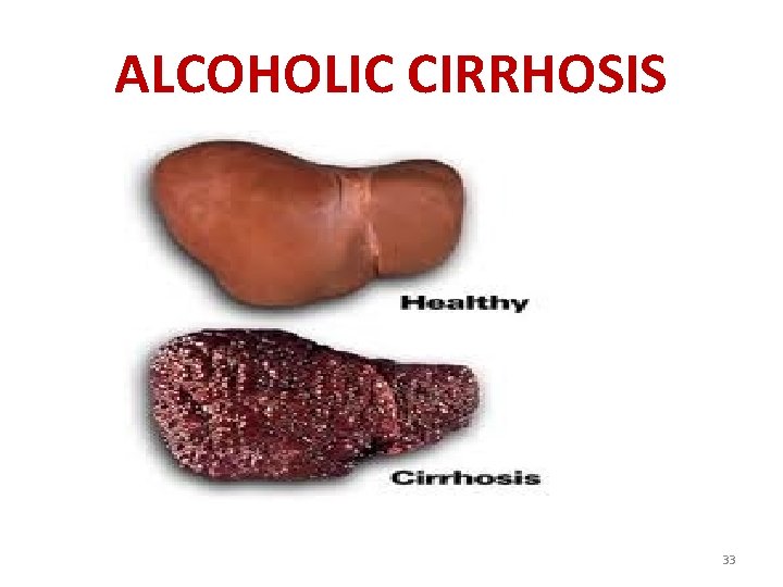 ALCOHOLIC CIRRHOSIS 33 