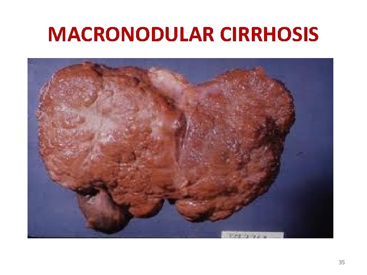 MACRONODULAR CIRRHOSIS 35 