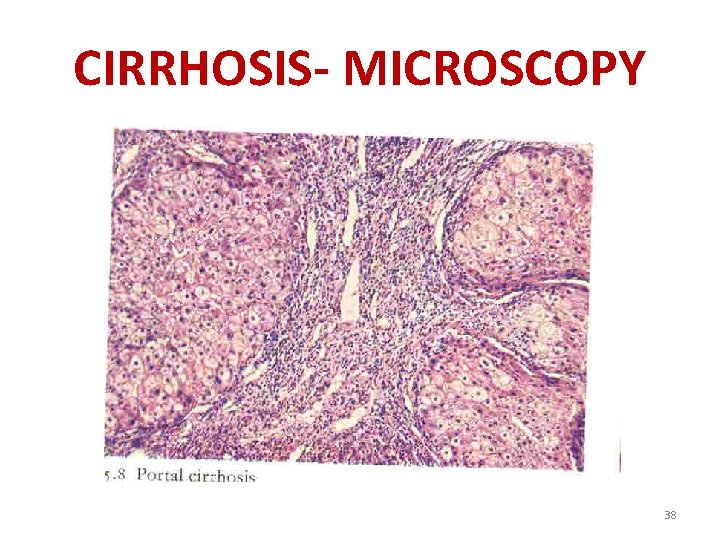 CIRRHOSIS- MICROSCOPY 38 