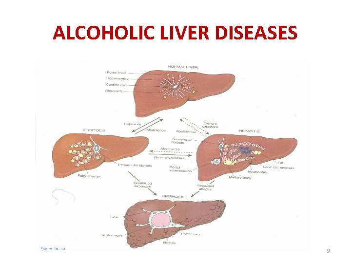 ALCOHOLIC LIVER DISEASES 9 