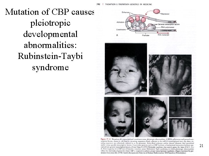 Mutation of CBP causes pleiotropic developmental abnormalities: Rubinstein-Taybi syndrome 21 