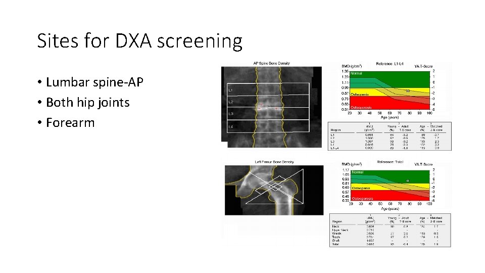 Sites for DXA screening • Lumbar spine-AP • Both hip joints • Forearm 