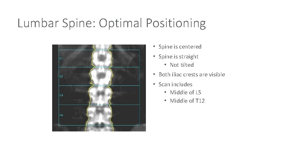 Lumbar Spine: Optimal Positioning • Spine is centered • Spine is straight • Not