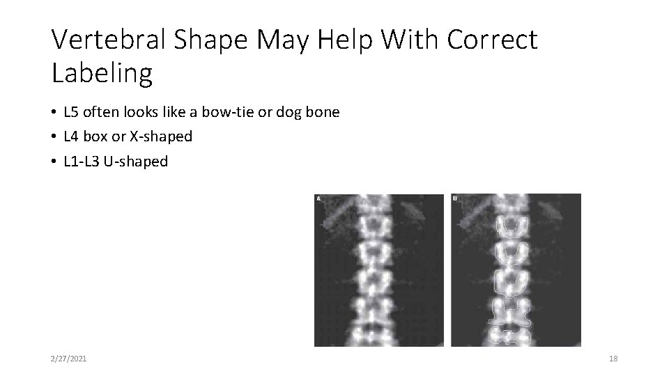Vertebral Shape May Help With Correct Labeling • L 5 often looks like a