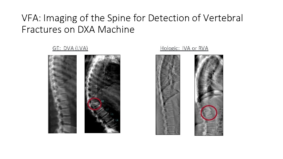 VFA: Imaging of the Spine for Detection of Vertebral Fractures on DXA Machine GE: