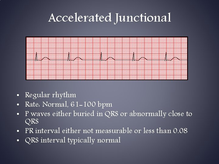 Accelerated Junctional • Regular rhythm • Rate: Normal, 61 -100 bpm • P waves Accelerated Junctional • Regular rhythm • Rate: Normal, 61 -100 bpm • P waves