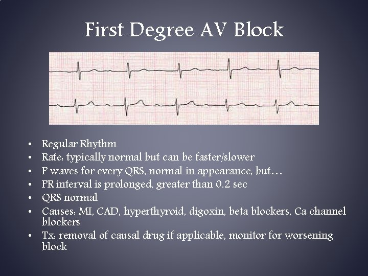First Degree AV Block Regular Rhythm Rate: typically normal but can be faster/slower P First Degree AV Block Regular Rhythm Rate: typically normal but can be faster/slower P