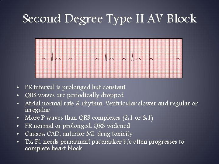 Second Degree Type II AV Block • PR interval is prolonged but constant •