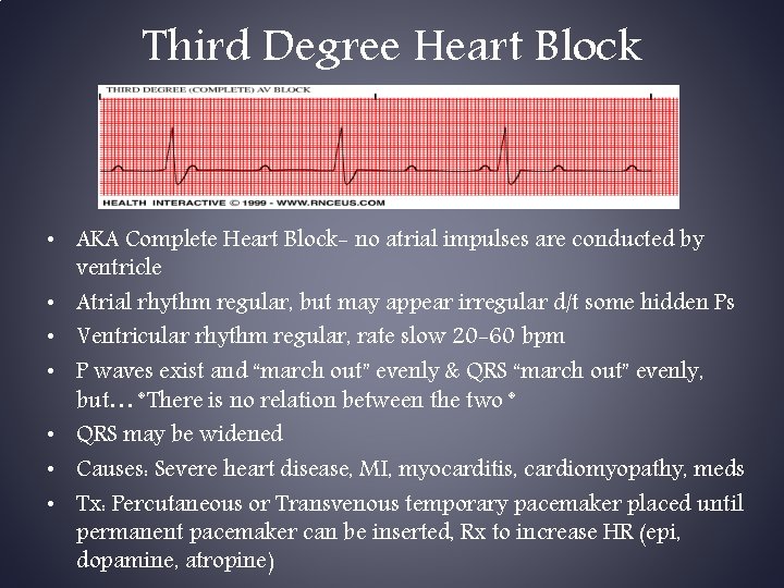 Third Degree Heart Block • AKA Complete Heart Block- no atrial impulses are conducted