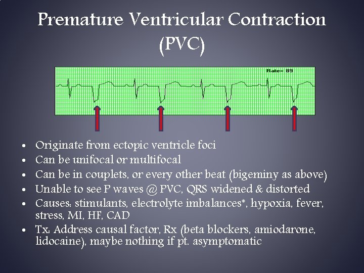 Premature Ventricular Contraction (PVC) Originate from ectopic ventricle foci Can be unifocal or multifocal