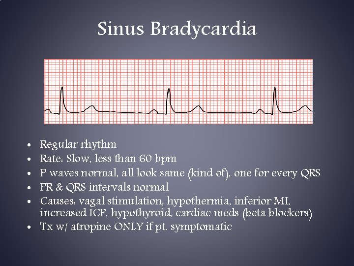 Sinus Bradycardia Regular rhythm Rate: Slow, less than 60 bpm P waves normal, all Sinus Bradycardia Regular rhythm Rate: Slow, less than 60 bpm P waves normal, all