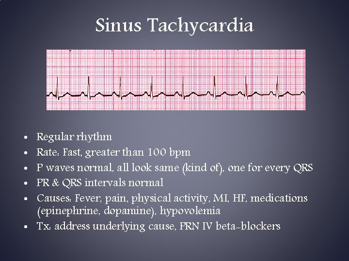 Sinus Tachycardia Regular rhythm Rate: Fast, greater than 100 bpm P waves normal, all