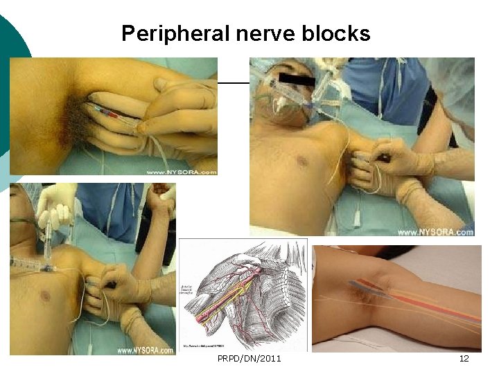 Peripheral nerve blocks PRPD/DN/2011 12 