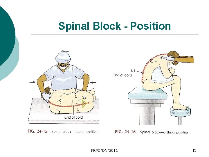 Spinal Block - Position PRPD/DN/2011 15 