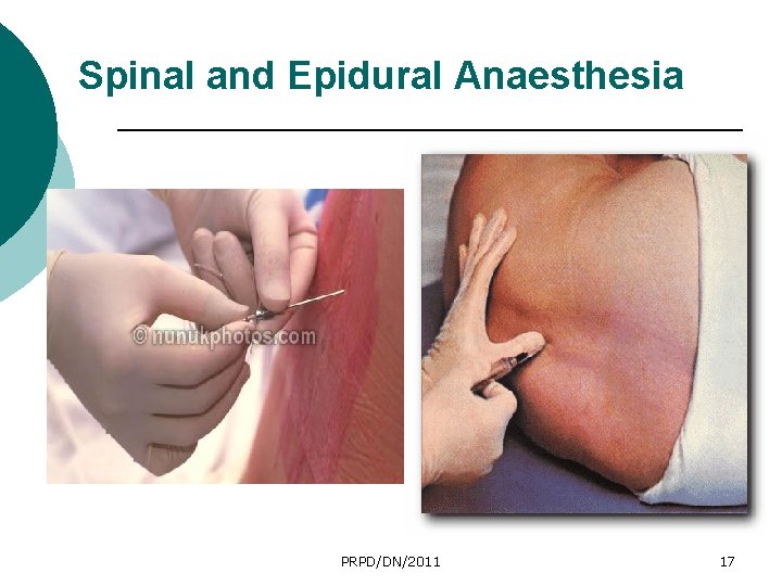 Spinal and Epidural Anaesthesia PRPD/DN/2011 17 