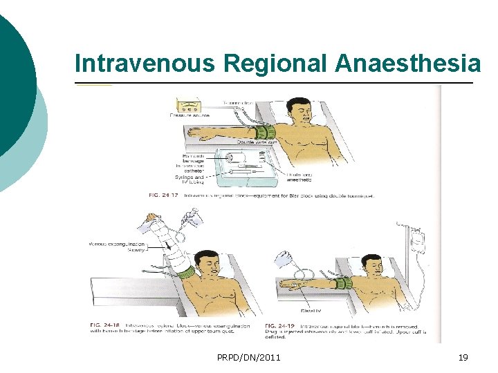 Intravenous Regional Anaesthesia PRPD/DN/2011 19 