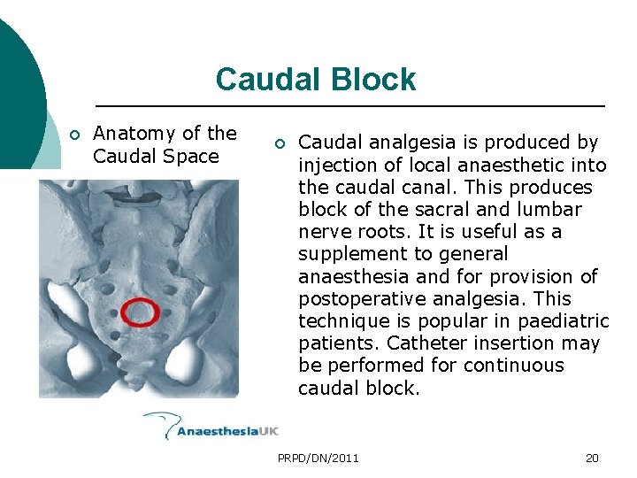 Caudal Block ¡ Anatomy of the Caudal Space ¡ Caudal analgesia is produced by