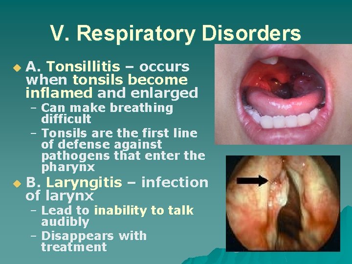 V. Respiratory Disorders u A. Tonsillitis – occurs when tonsils become inflamed and enlarged