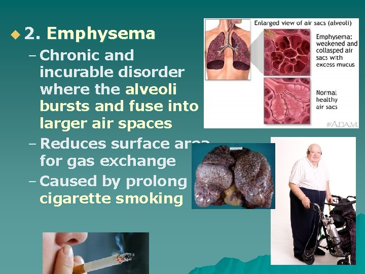 u 2. Emphysema – Chronic and incurable disorder where the alveoli bursts and fuse