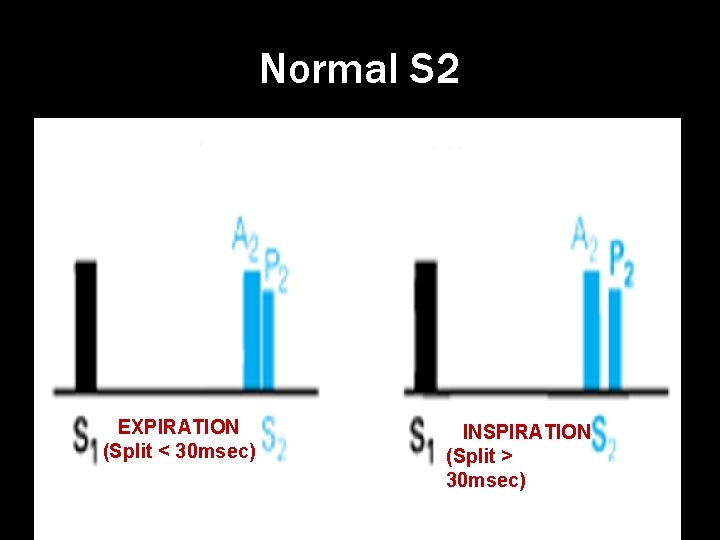 Normal S 2 EXPIRATION (Split < 30 msec) INSPIRATION (Split > 30 msec) 
