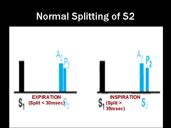 Normal Splitting of S 2 EXPIRATION (Split < 30 msec) INSPIRATION (Split > 30
