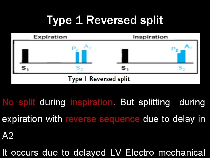 Type 1 Reversed split No split during inspiration. But splitting during expiration with reverse