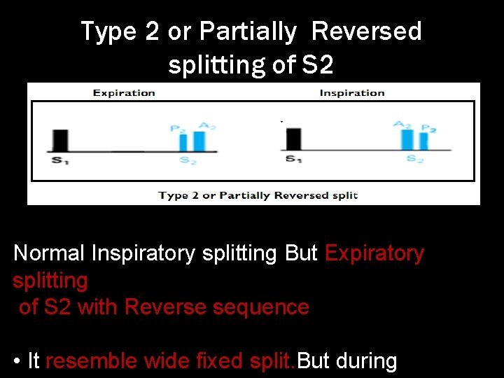 Type 2 or Partially Reversed splitting of S 2 Normal Inspiratory splitting But Expiratory