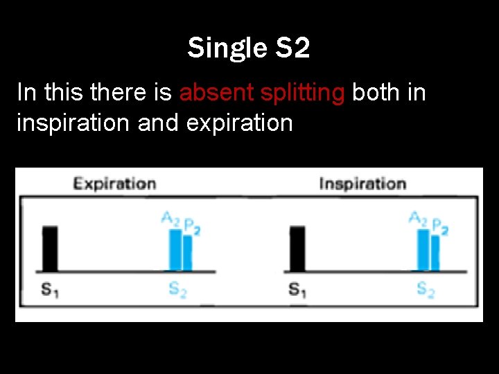 Single S 2 In this there is absent splitting both in inspiration and expiration