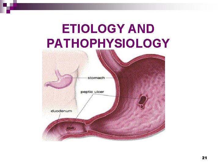 ETIOLOGY AND PATHOPHYSIOLOGY 21 