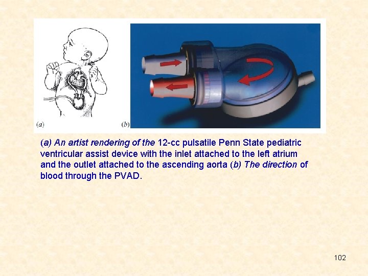 (a) An artist rendering of the 12 -cc pulsatile Penn State pediatric ventricular assist