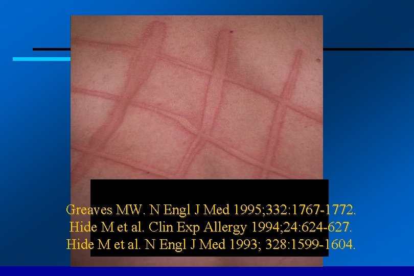 Greaves MW. N Engl J Med 1995; 332: 1767 -1772. Hide M et al.
