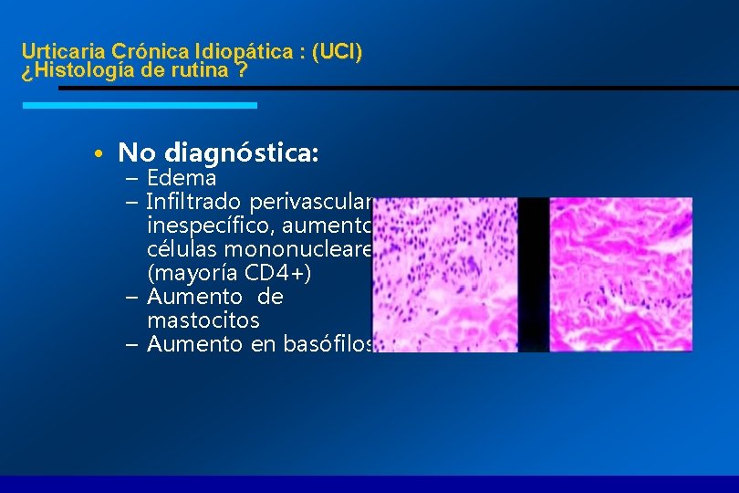 Urticaria Crónica Idiopática : (UCI) ¿Histología de rutina ? • No diagnóstica: – Edema