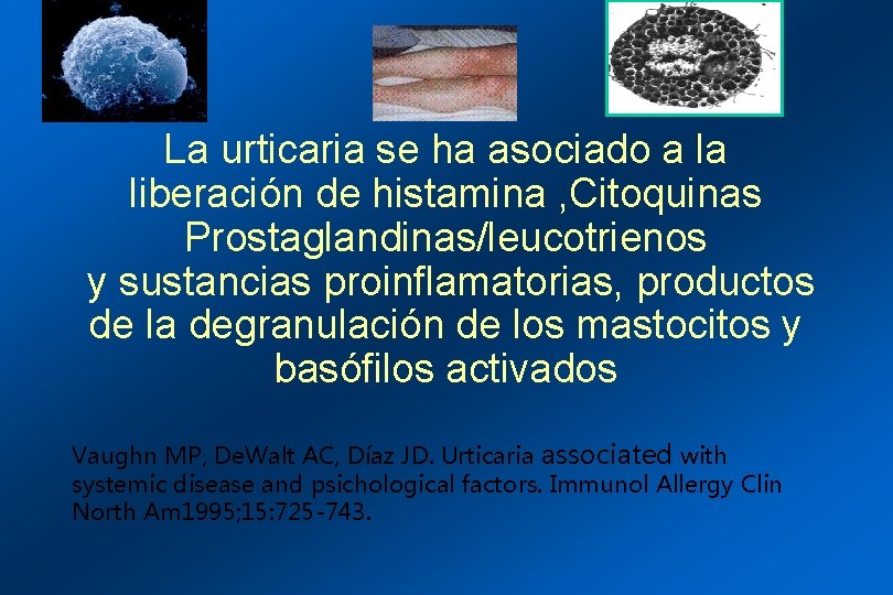 La urticaria se ha asociado a la liberación de histamina , Citoquinas Prostaglandinas/leucotrienos y