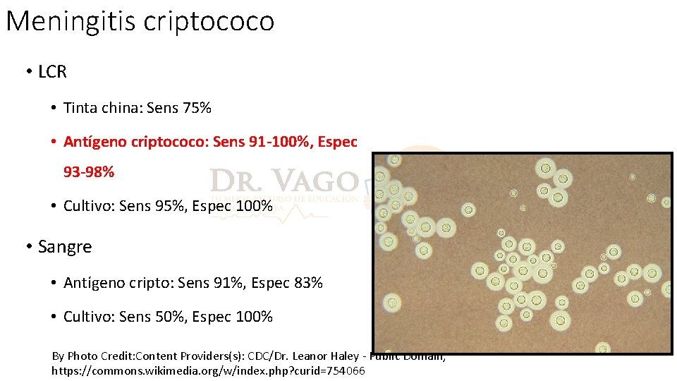 Meningitis criptococo • LCR • Tinta china: Sens 75% • Antígeno criptococo: Sens 91