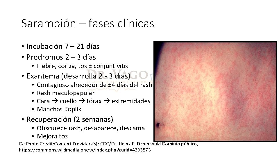 Sarampión – fases clínicas • Incubación 7 – 21 días • Pródromos 2 –