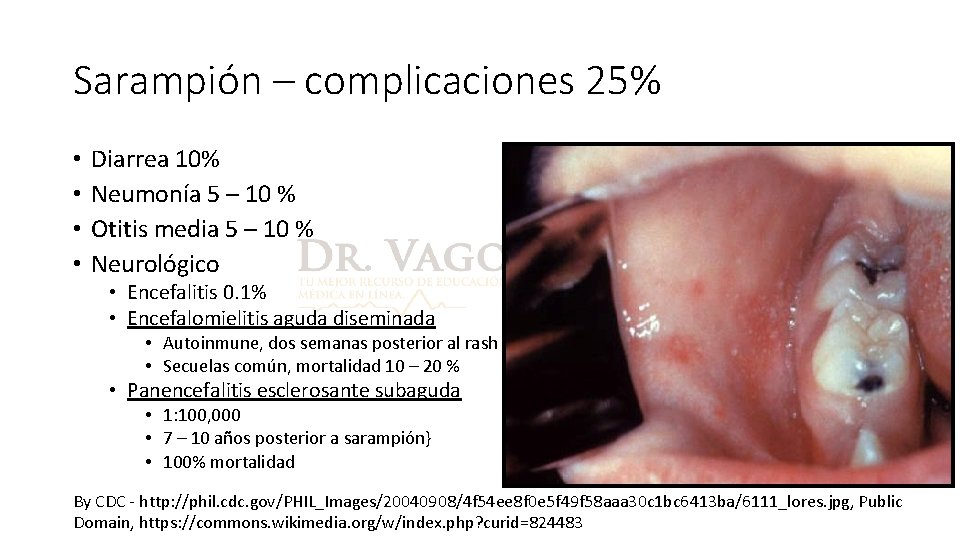 Sarampión – complicaciones 25% • • Diarrea 10% Neumonía 5 – 10 % Otitis