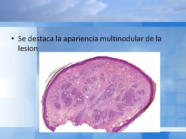  • Se destaca la apariencia multinodular de la lesion 