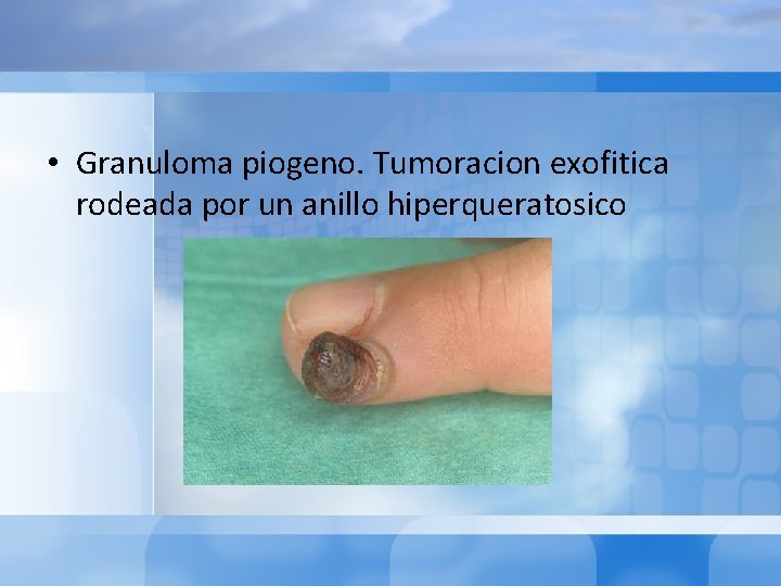  • Granuloma piogeno. Tumoracion exofitica rodeada por un anillo hiperqueratosico 