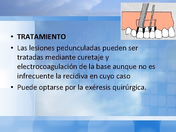  • TRATAMIENTO • Las lesiones pedunculadas pueden ser tratadas mediante curetaje y electrocoagulación