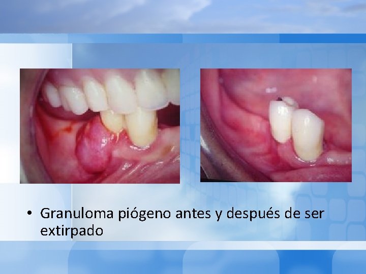  • Granuloma piógeno antes y después de ser extirpado 