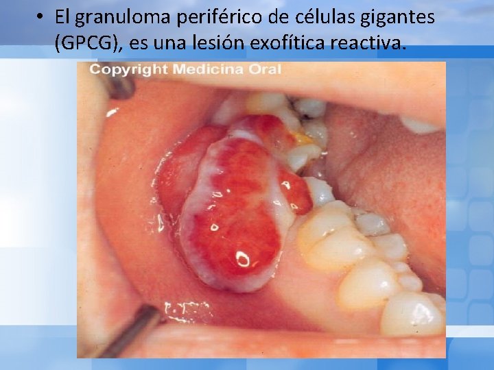  • El granuloma periférico de células gigantes (GPCG), es una lesión exofítica reactiva.