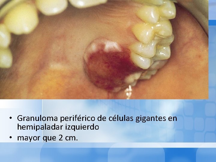  • Granuloma periférico de células gigantes en hemipaladar izquierdo • mayor que 2