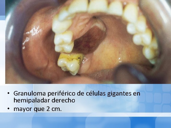  • Granuloma periférico de células gigantes en hemipaladar derecho • mayor que 2