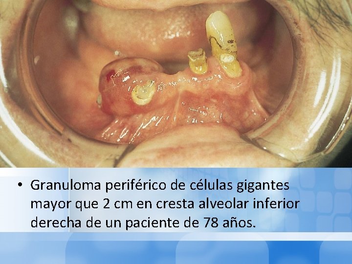  • Granuloma periférico de células gigantes mayor que 2 cm en cresta alveolar