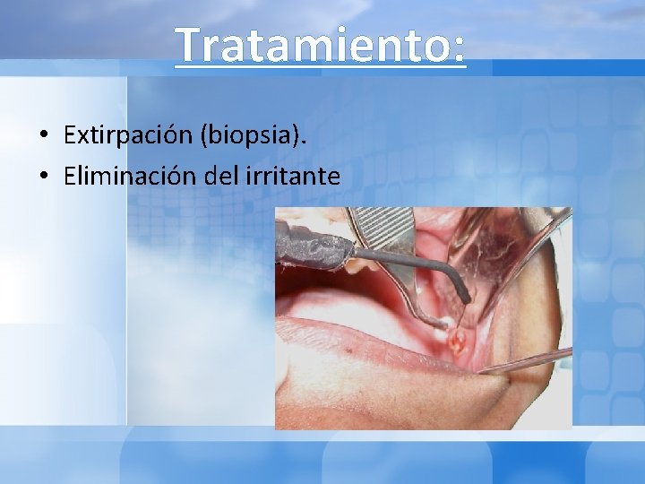 Tratamiento: • Extirpación (biopsia). • Eliminación del irritante 