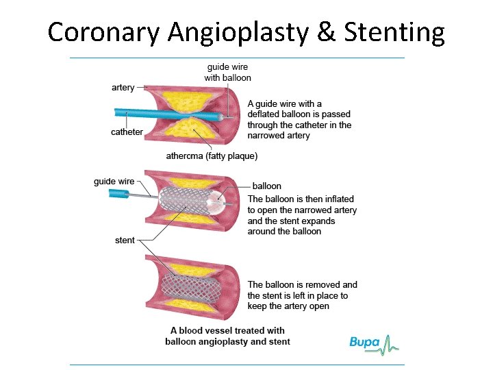 Coronary Angioplasty & Stenting 